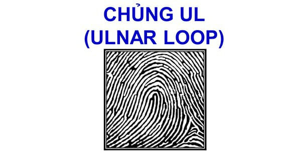 Chủng vân tay Ulnar Loop (UL)